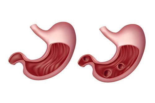 Symptoms of Duodenal Ulcer: Common Management Techniques